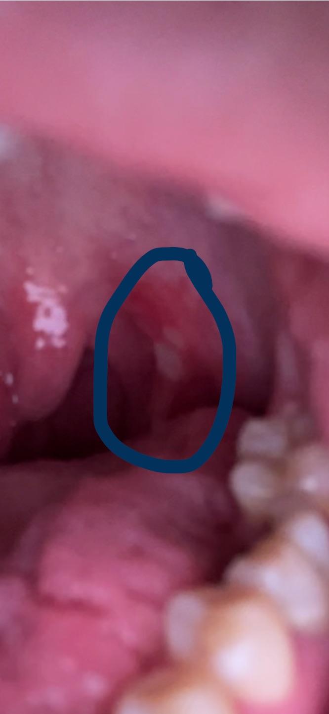 Canker Sore On Tonsil Cause