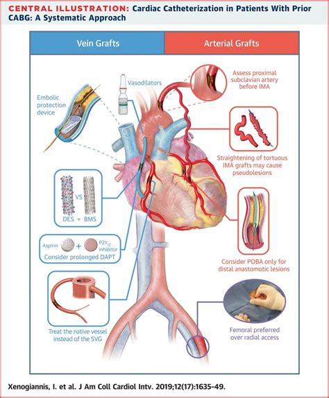 Cardiac Cath Diagram Explained
