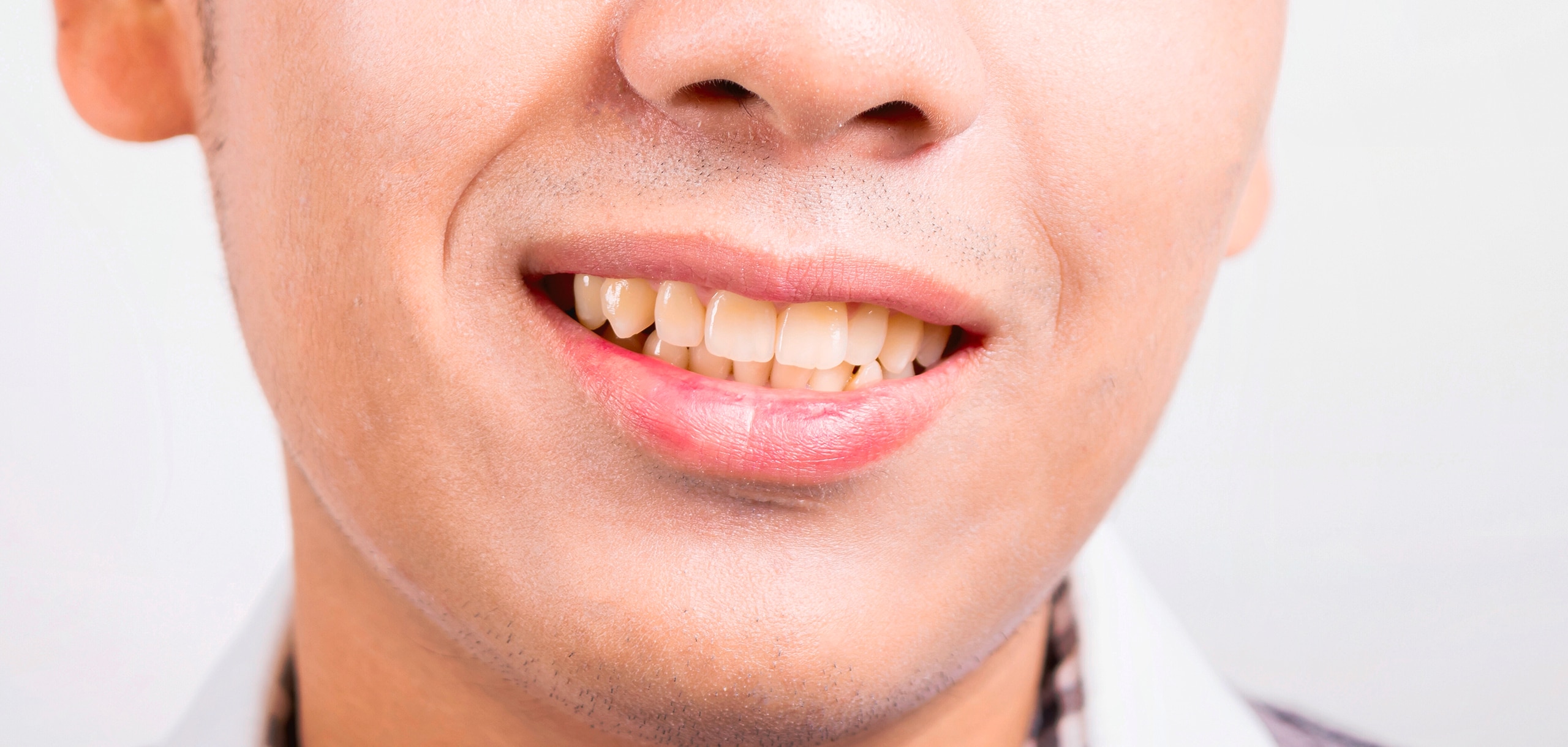 Causes Of Yellow Teeth And How To Get Rid Of It Ilajak Medical Causes Of Yellow Teeth And How To Get Rid Of It Ilajak Medical