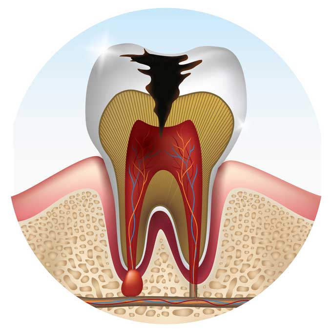 Cavity In My Wisdom Tooth