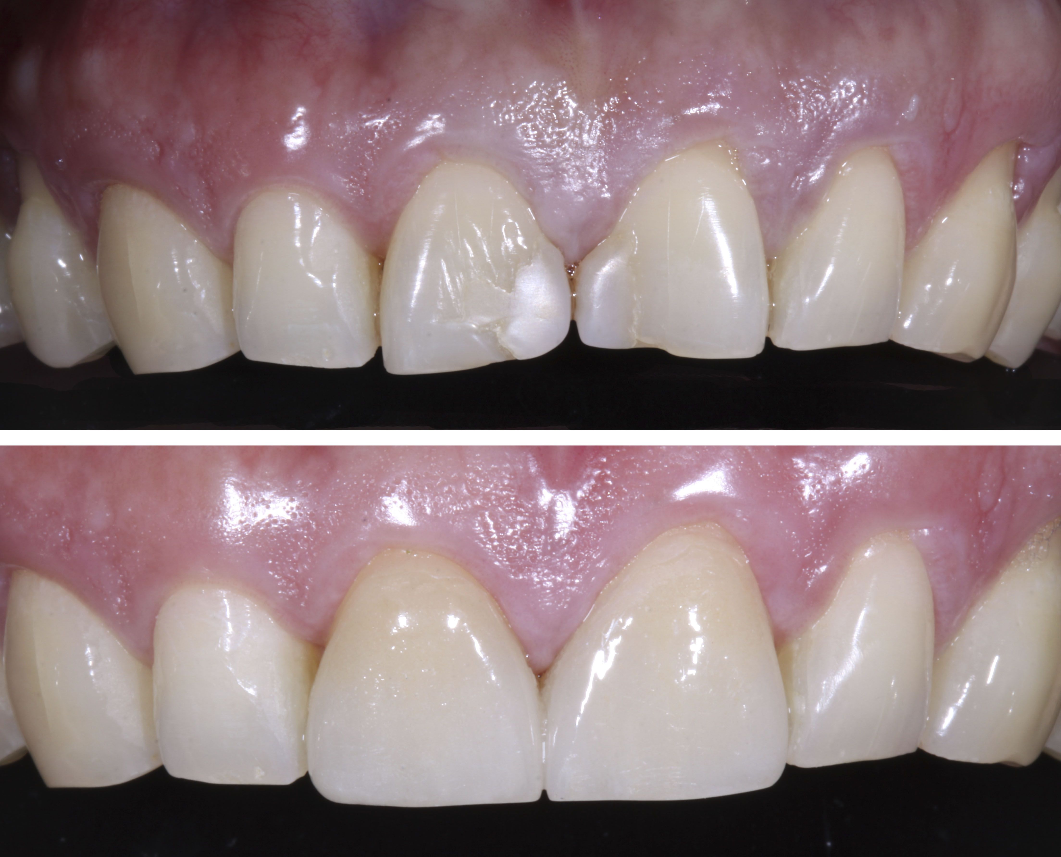 Cavity On My Front Tooth