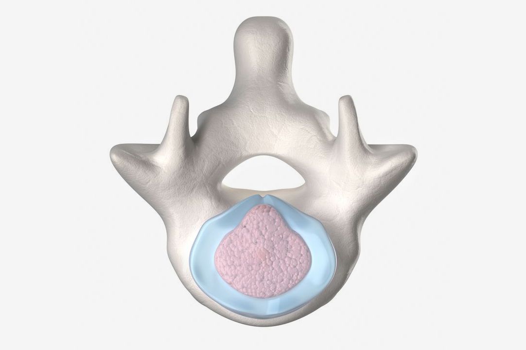 Central Protrusion With Annular Fissure