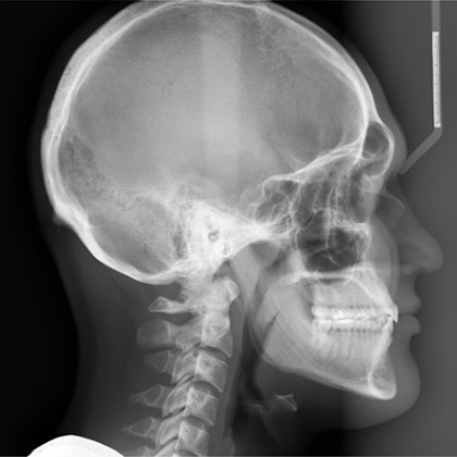 Cephalometric X Ray
