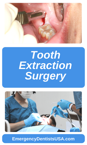 Cheap Tooth Extraction: Find Lowcost Dentists