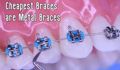Cheapest Braces For Adults