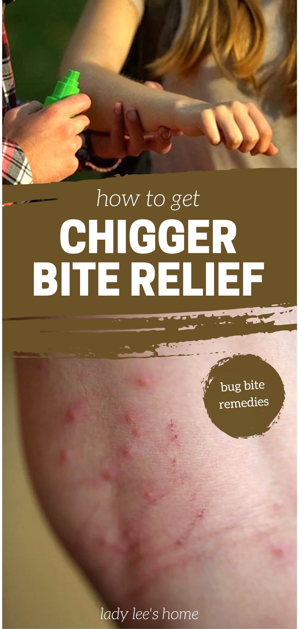 Chigger Bite: Identify And Treat Itchy Bites Chigger Bite: Identify And Treat Itchy Bites