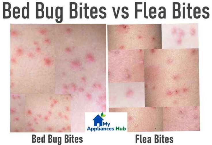 Chigger Vs Flea Bites