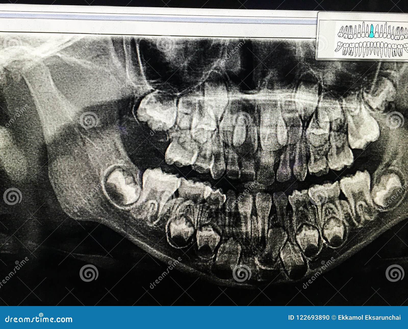 Childrens Teeth Xray