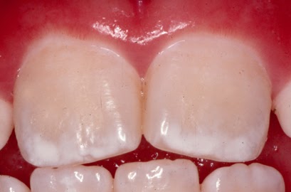 Child's Teeth White Spots Child's Teeth White Spots