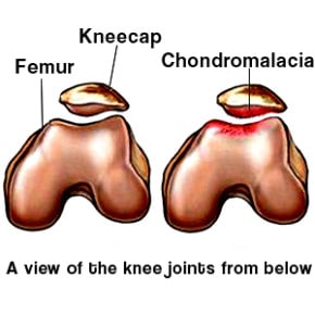Chondromalacia Relief: Modify Activities Chondromalacia Relief: Modify Activities