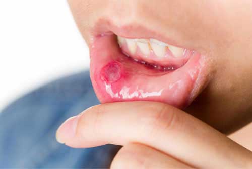 Clove Good For Mouth Ulcer