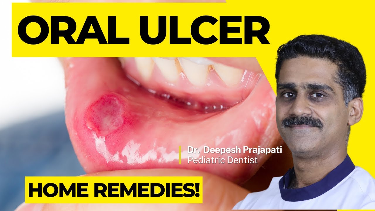 Coeliac And Mouth Ulcers
