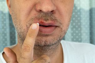 Cold Sore Vs Impetigo Pictures