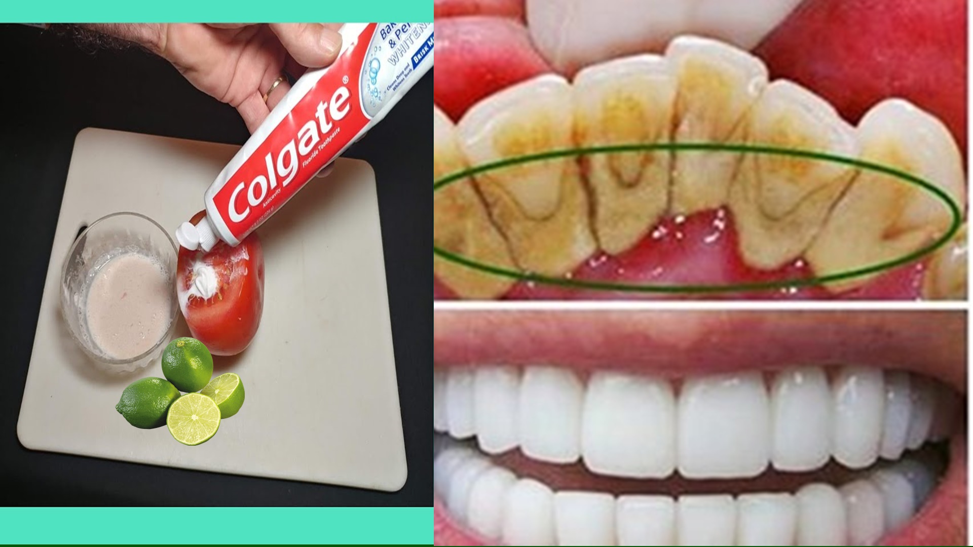 Colgate Para Blanquear Los Dientes