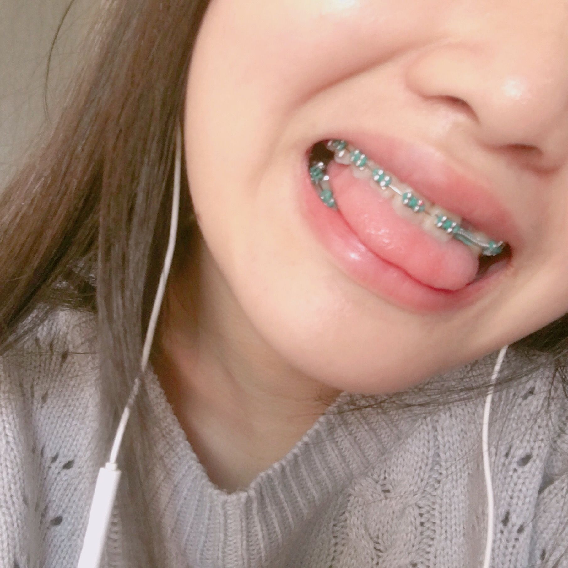 Color Braces Teeth