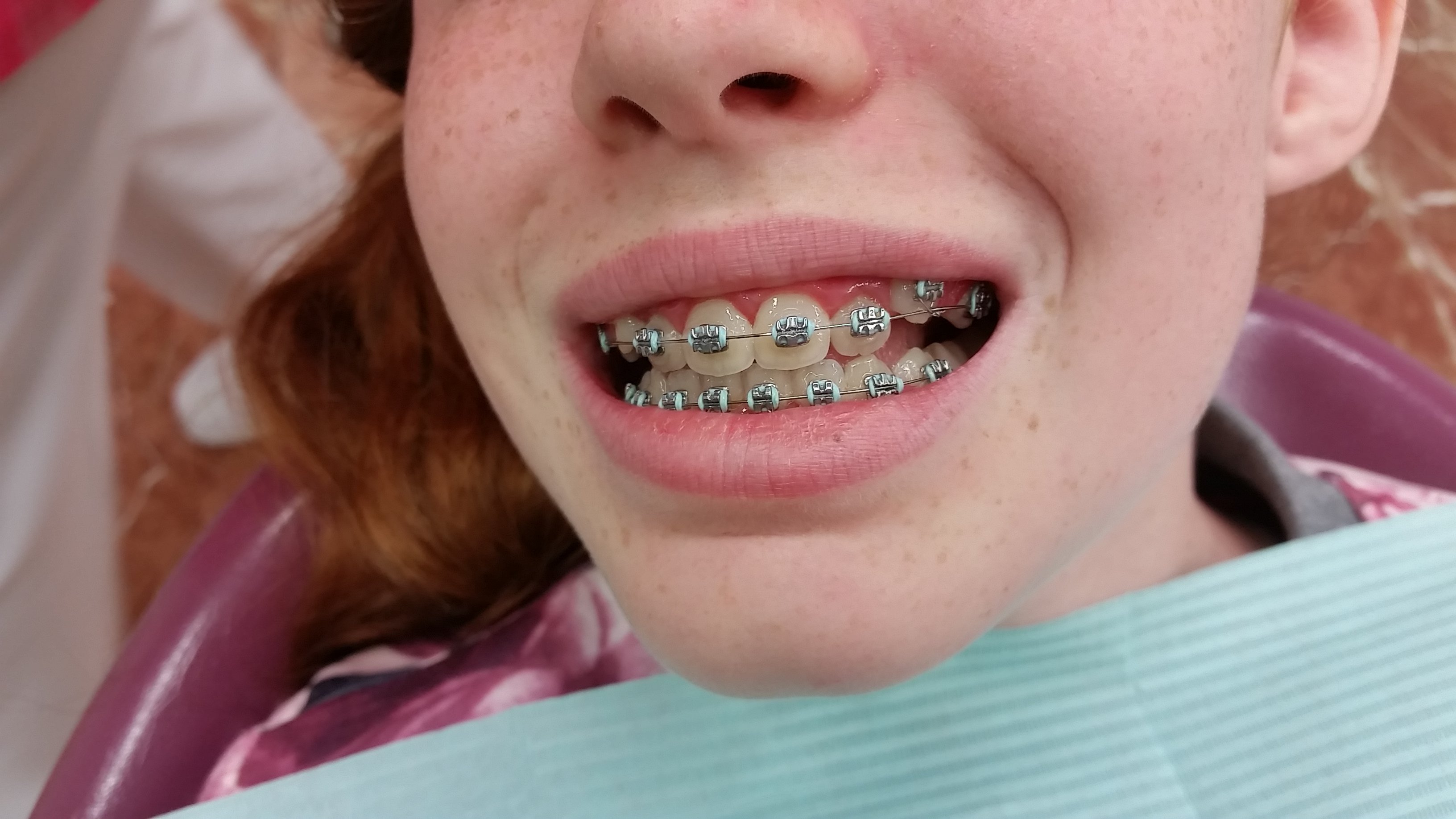 Colores Para Brackets