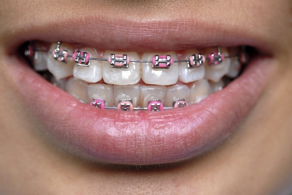 Coloured Braces Teeth