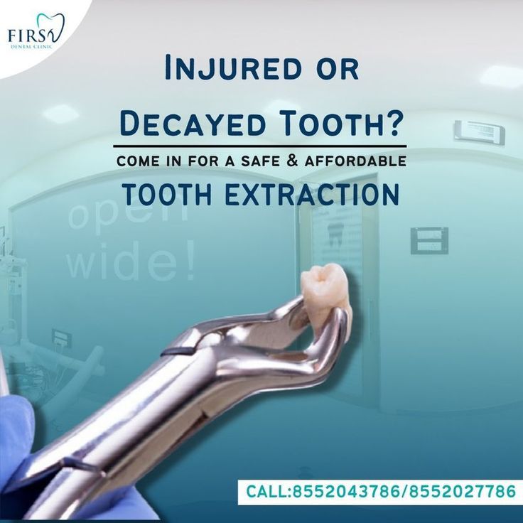 Come In For Safe Affordable Tooth Extraction Em 2024 Come In For Safe Affordable Tooth Extraction Em 2024
