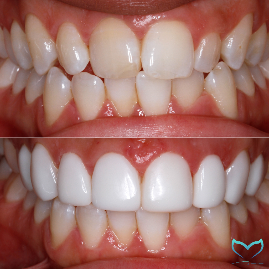 Composite Teeth Veneers Guide: Perfect Smiles