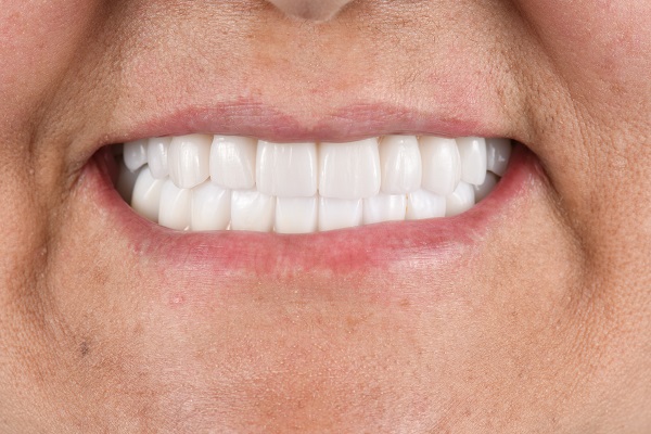 Composite Veneers: Fix Imperfections
