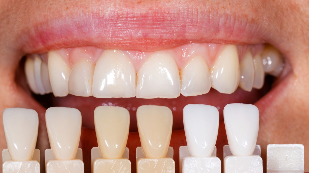Composite Veneers Or Porcelain