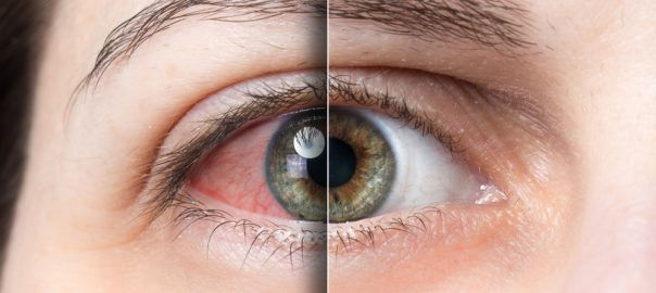Contacts Make My Eyes Red