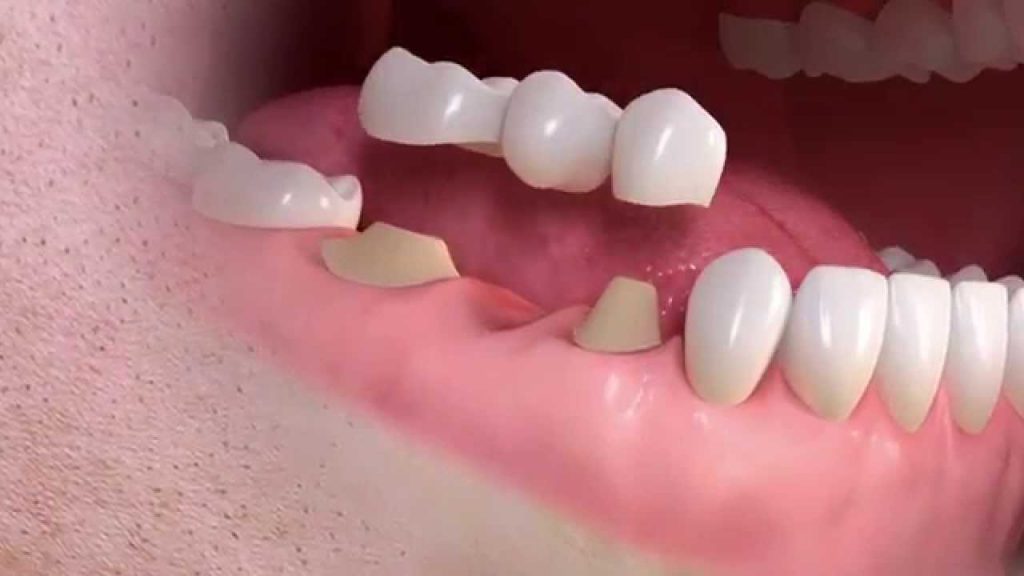 Conventional Dental Bridge