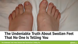 Copd Swollen Feet