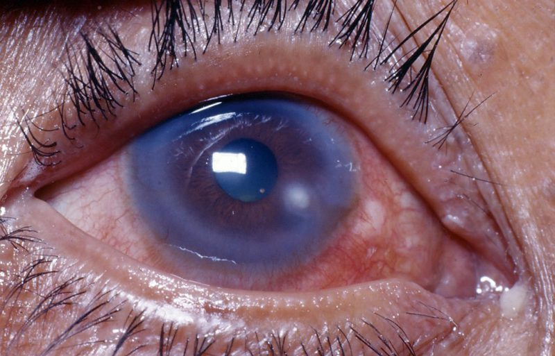 Corneal Ulcer: View Photos For Diagnosis Help