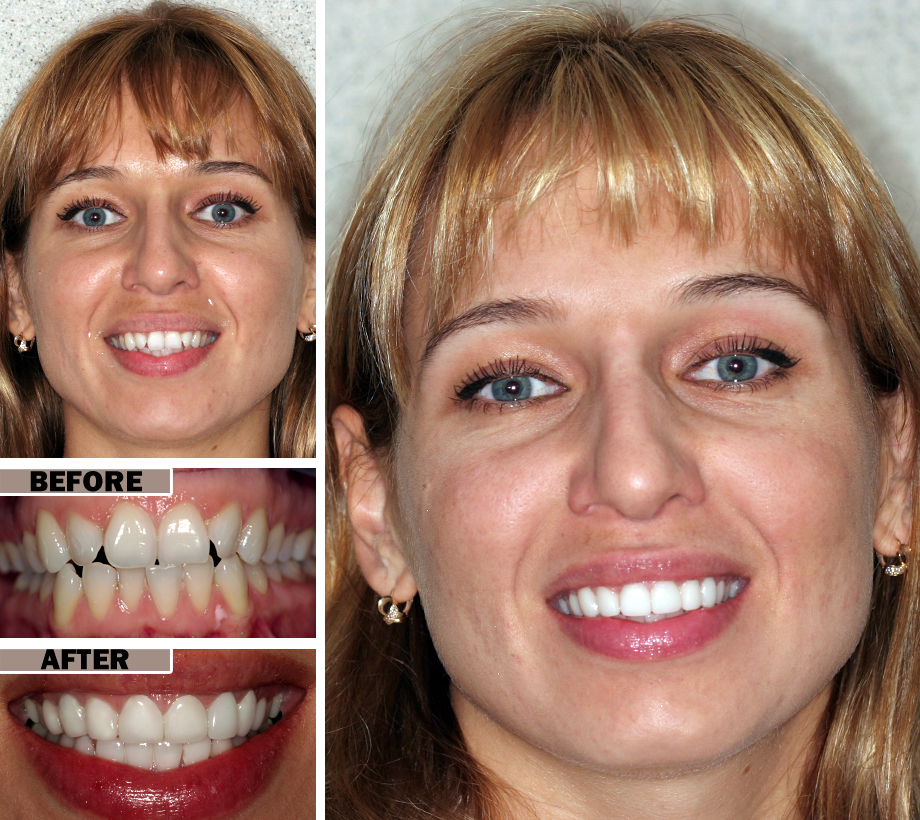 Cosmetic Bonding Teeth
