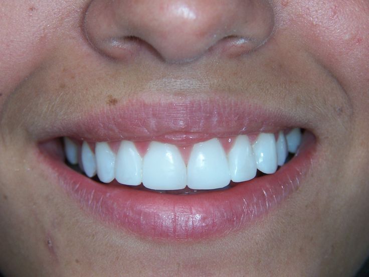 Cosmetic Teeth Bonding Near Me