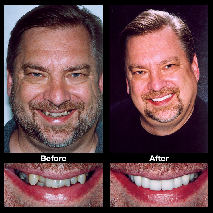 Crooked Teeth Smile