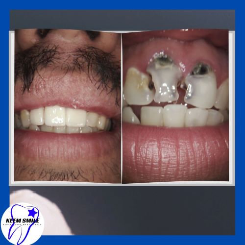Crown Front Teeth