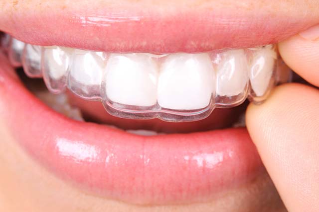 Crowns And Bridges: Fix Teeth Permanently Today