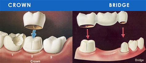 Crowns And Bridges For Teeth