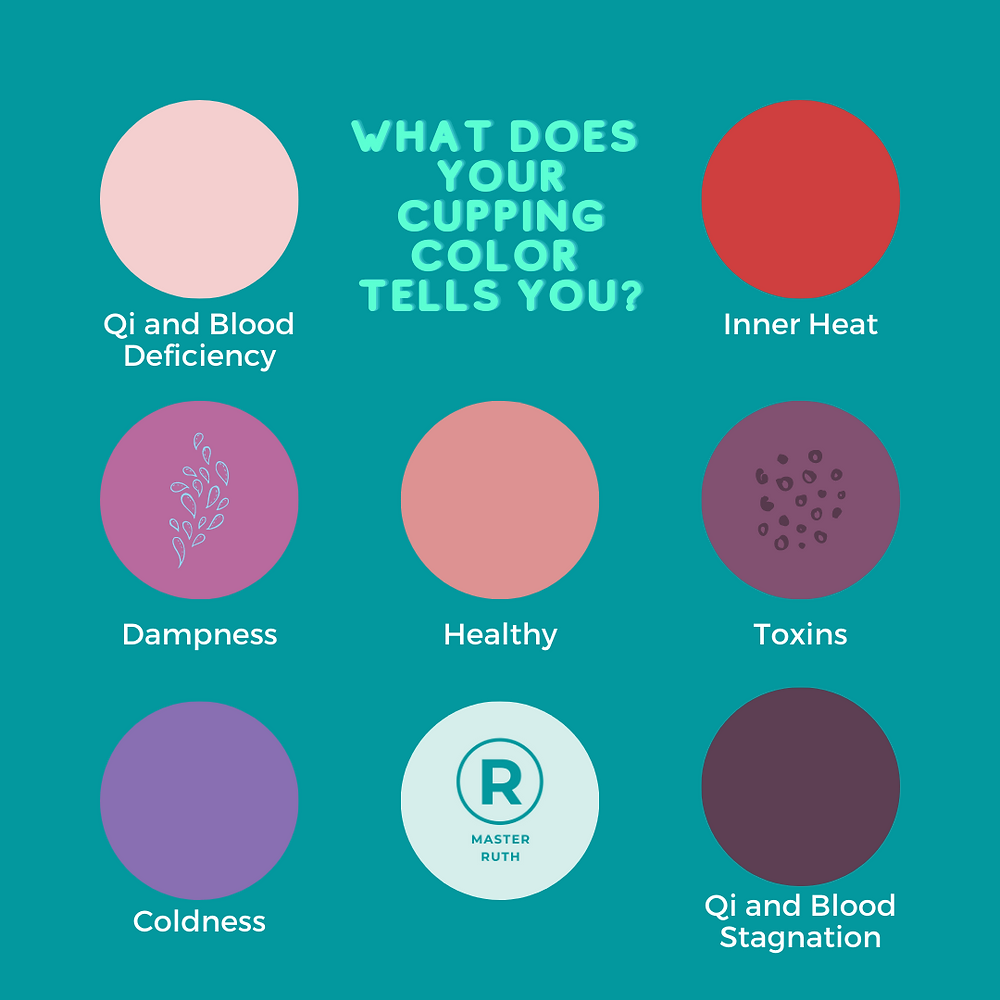 Cupping For Fibromyalgia