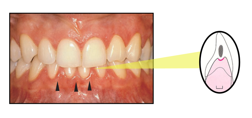 Cut Gum In Between Teeth