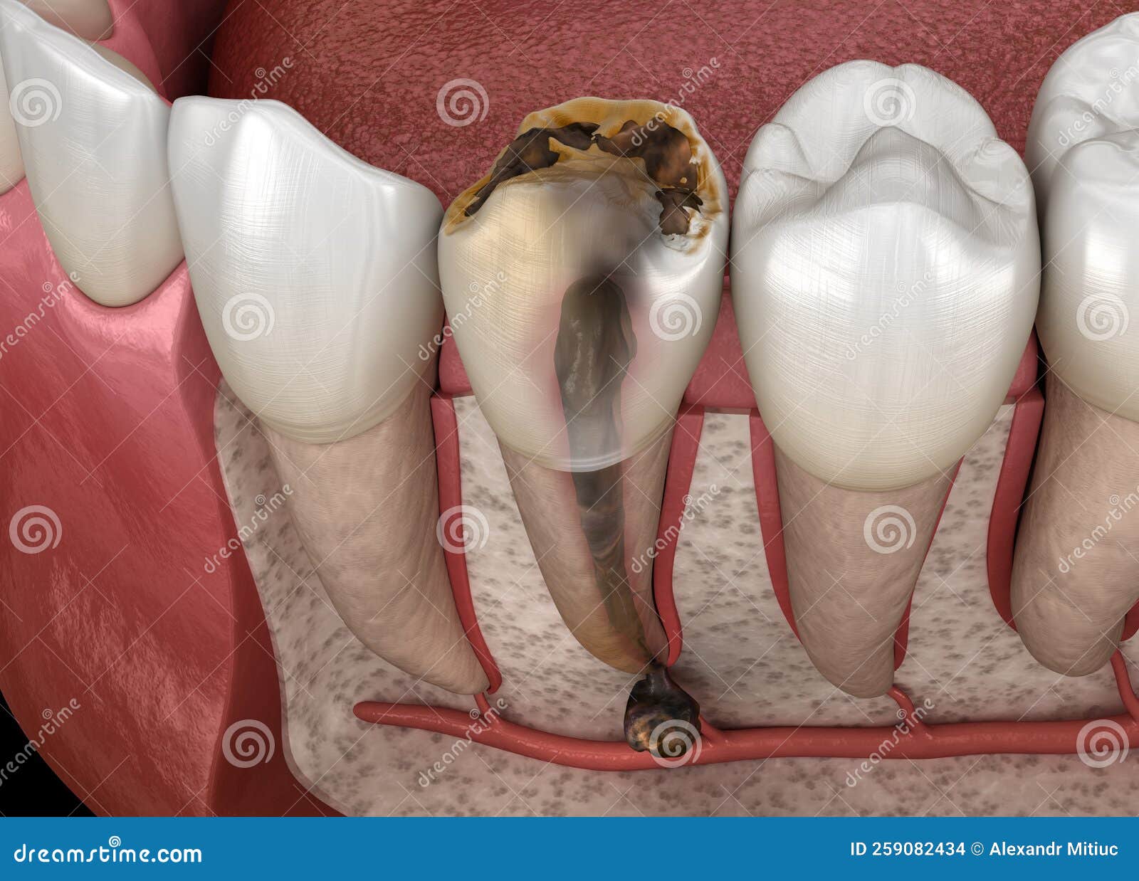 Cut On Gum Above Tooth
