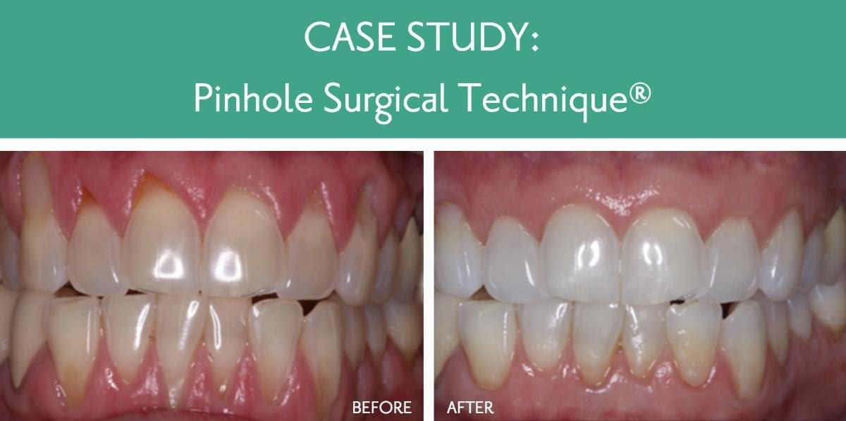Cut On Gums Between Teeth