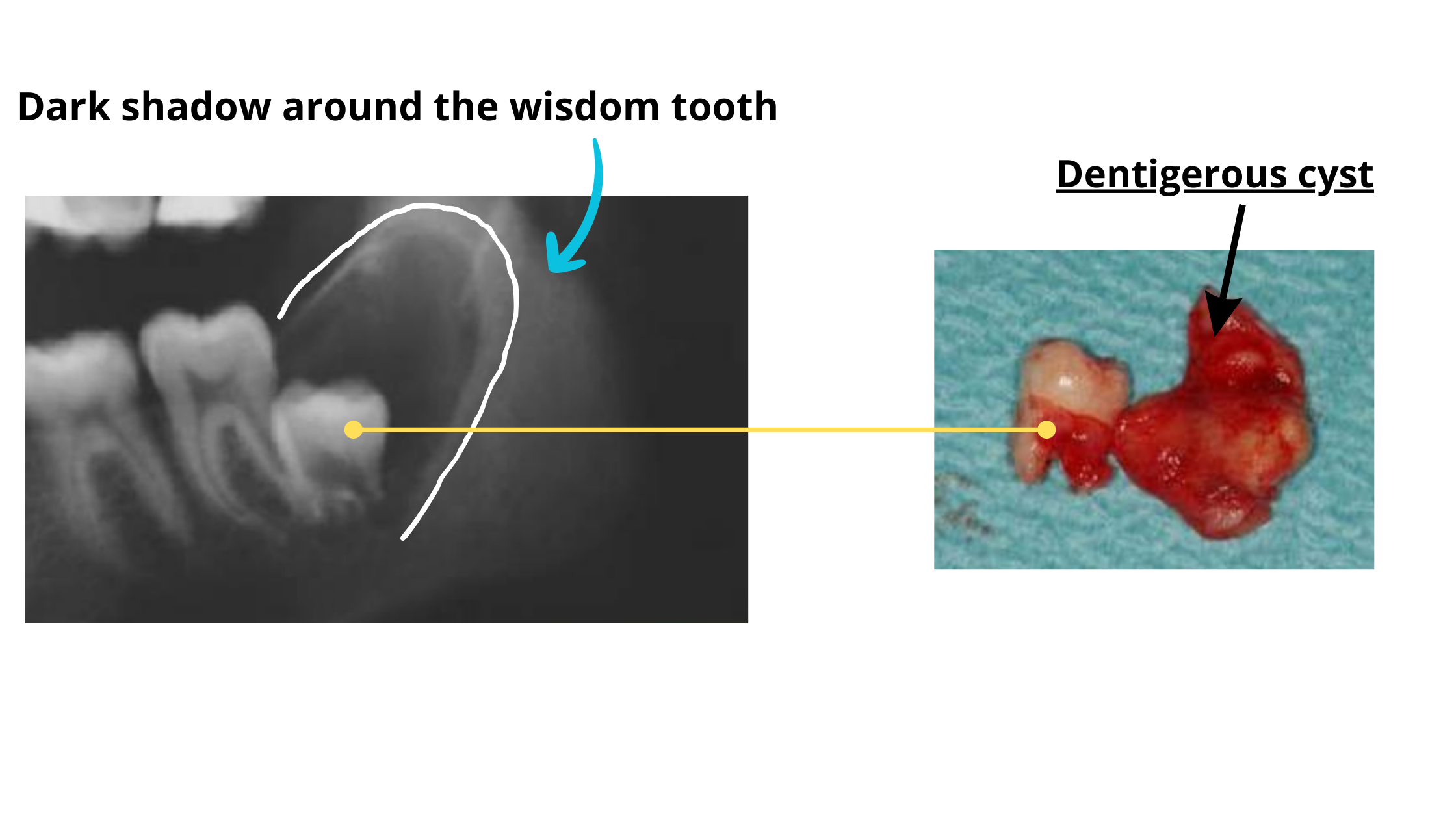 Cyst On Tooth