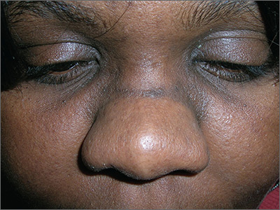 Dark Line Nose Removal Guide
