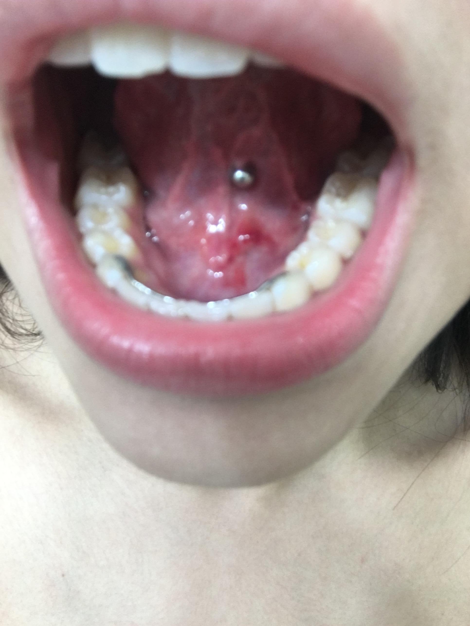 Dark Spot On Tongue
