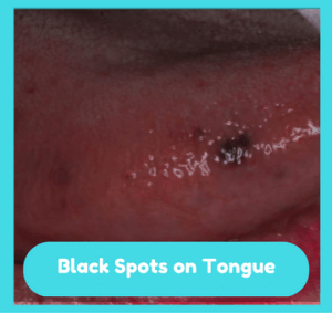 Dark Spots In Tongue