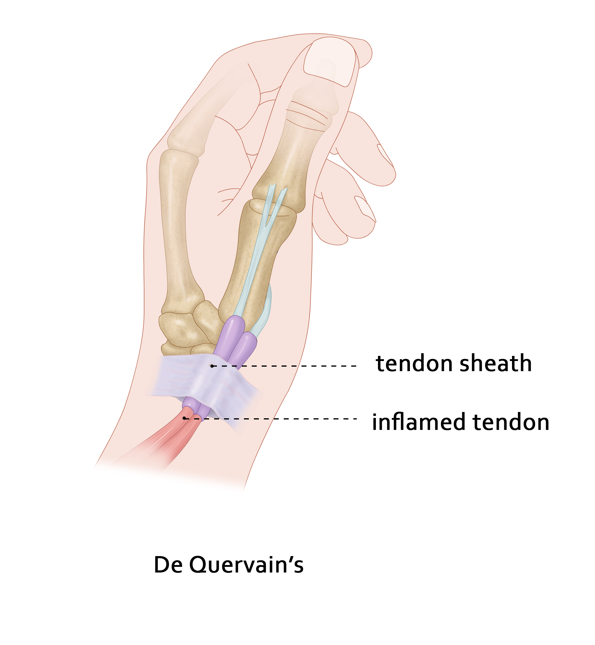 De Quervain's Surgery Cast: Relief In 6 Weeks
