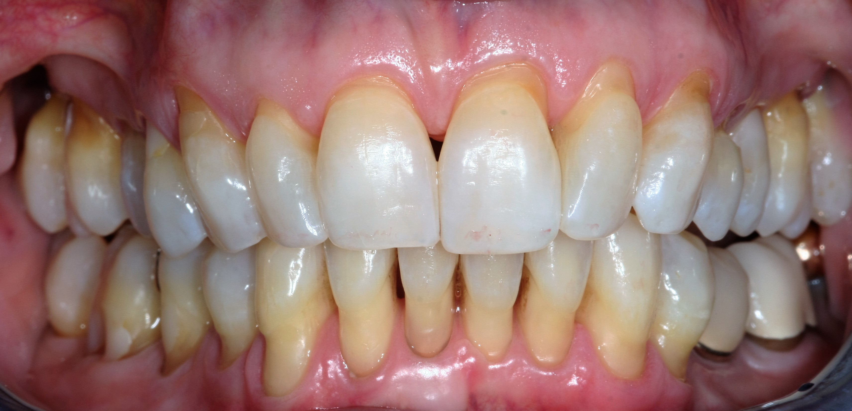 Deep Pockets Teeth: Fix Receding Gums Easily