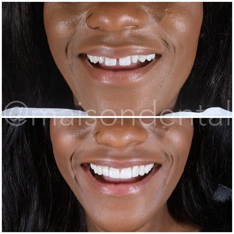 Dental Bonding For Gap