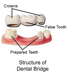Dental Bridge Diagram Labeled