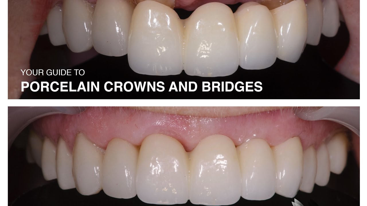 Dental Bridge Front Teeth Fixed Teeth Youtube Dental Bridge Front Teeth Fixed Teeth Youtube