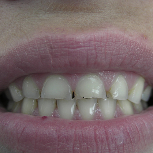 Dental Bridge Services