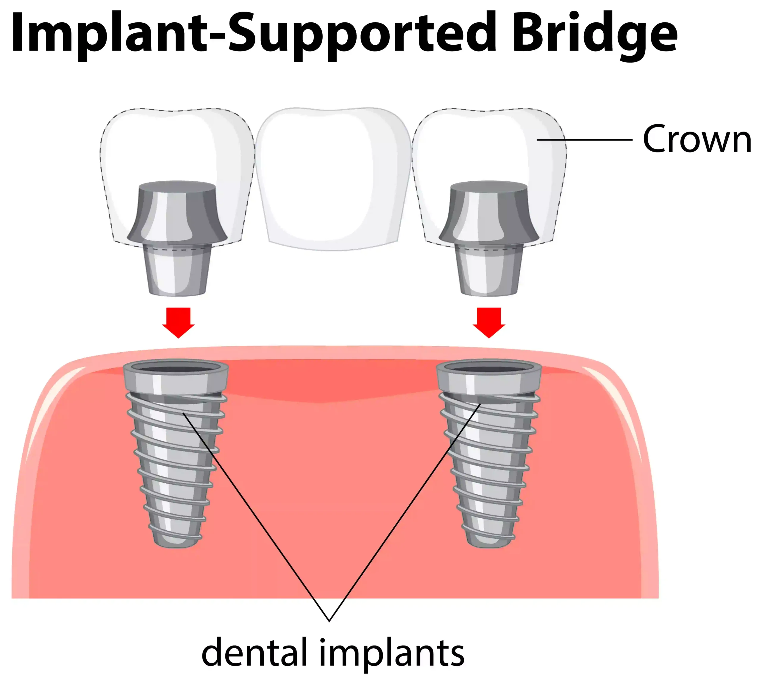 Dental Bridge Vs Implant